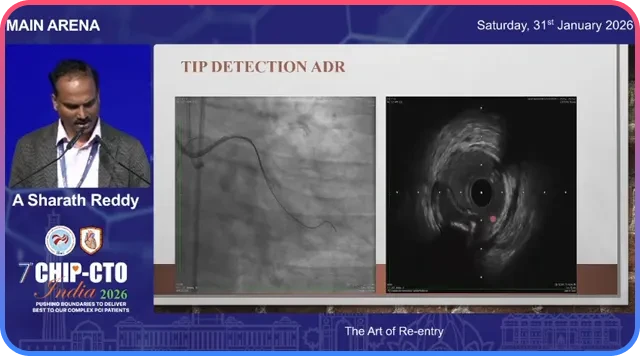 IVUS Guidance